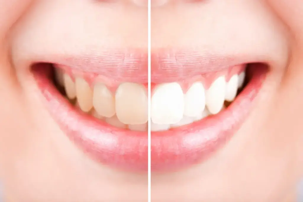 Beyond the Surface: Why Preventive Dentistry is the Ultimate Guardian of Whitening and Veneers